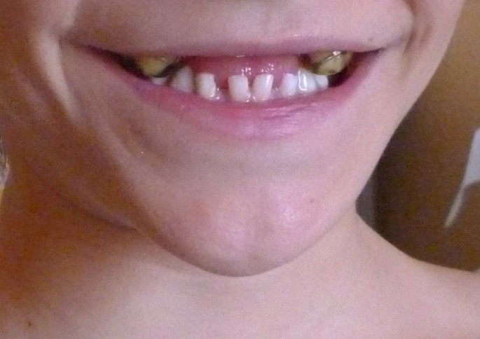 Does Ehlers Danlos Affect Teeth?